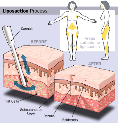 Cellulite And Liposuction | Cellulite